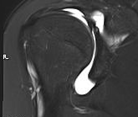 Perthes Lesion MRI 1